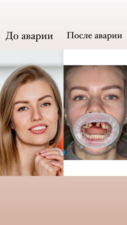 Изуродованный аварией рот Натальи